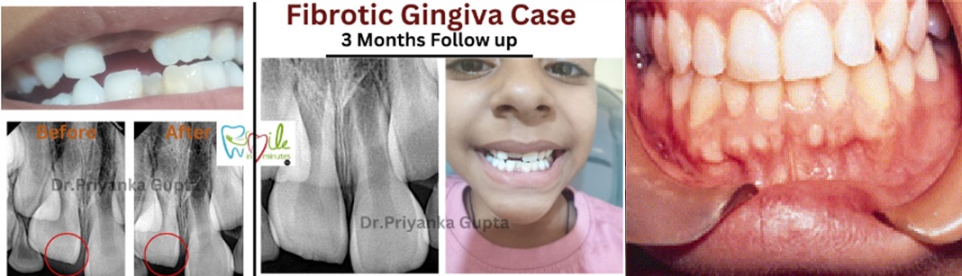 Thick Fibrotic Gingiva- All You Should Know About It